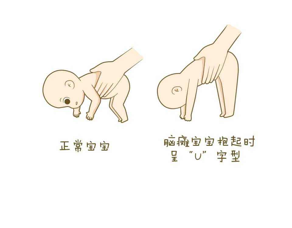 脑瘫能在孕期查出来吗？